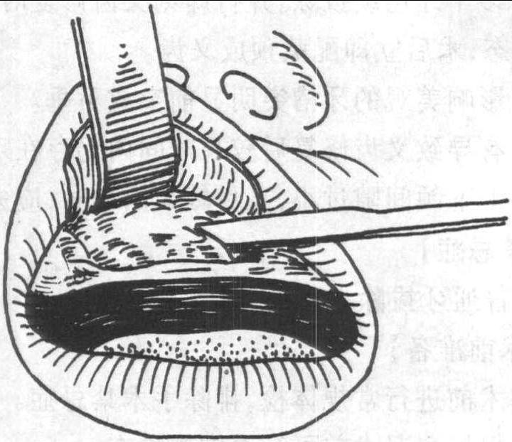 牙槽突修整術(shù)
